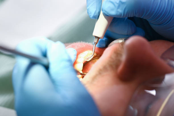 Best Emergency Tooth Extraction in Buena Vista, VA
