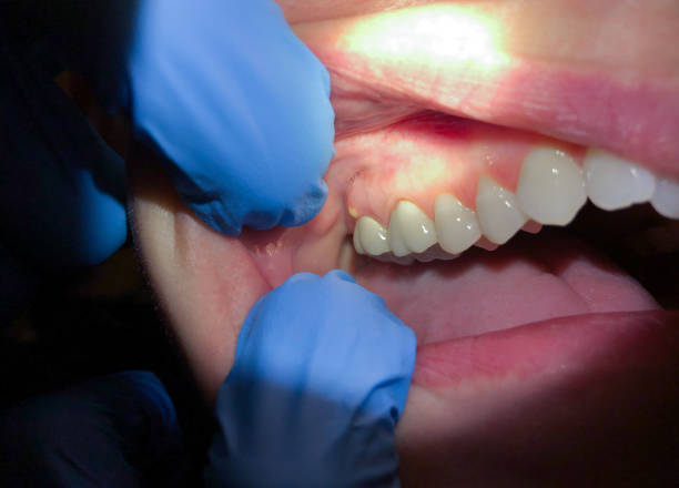 Best Emergency Tooth Extraction in Buena Vista, VA